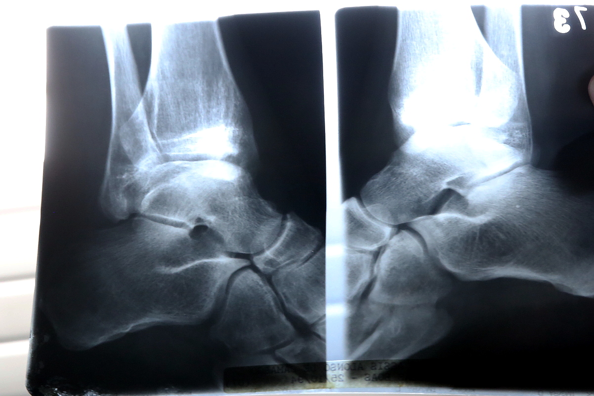 Data do Dia da Conscientização da Osteoporose pode ser alterada