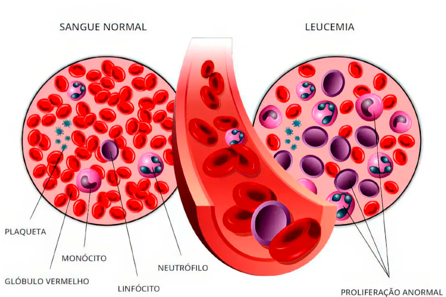 Fevereiro pode se tornar o mês da conscientização sobre leucemia em Curitiba
