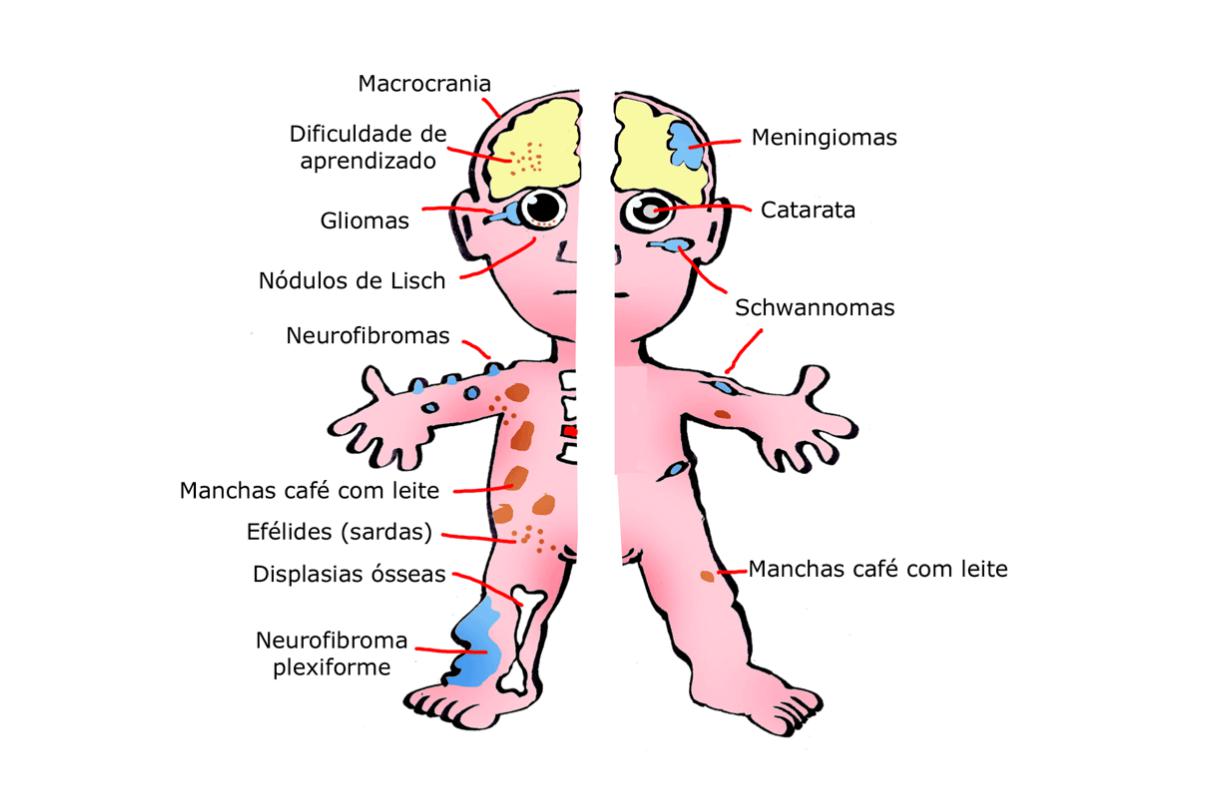 Maio pode ter ações de conscientização às neurofibromatoses